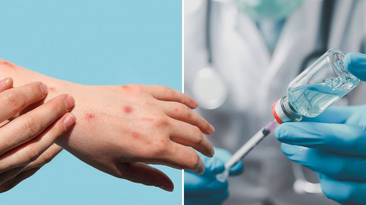 Reporta Texas 561 casos de sarampión; estos son los condados que tienen más contagios