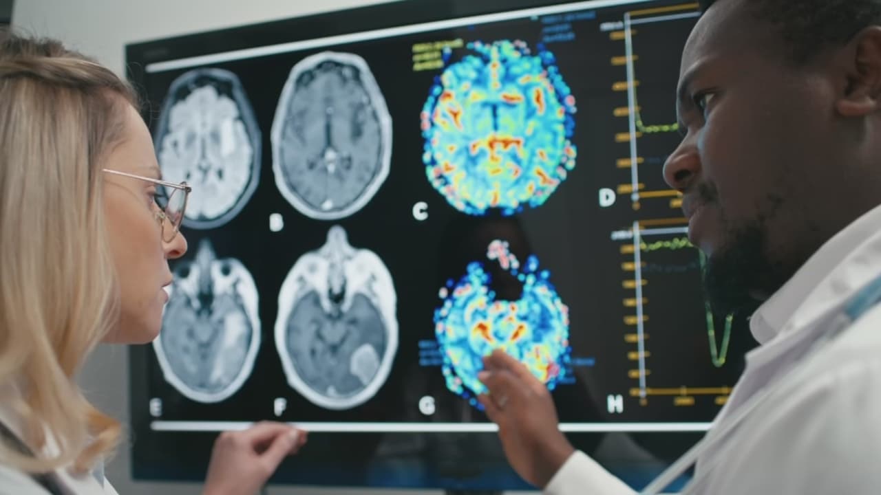 Estudio revela un aumento en las tasas de derrames cerebrales en adultos jóvenes de 20 a 54 años