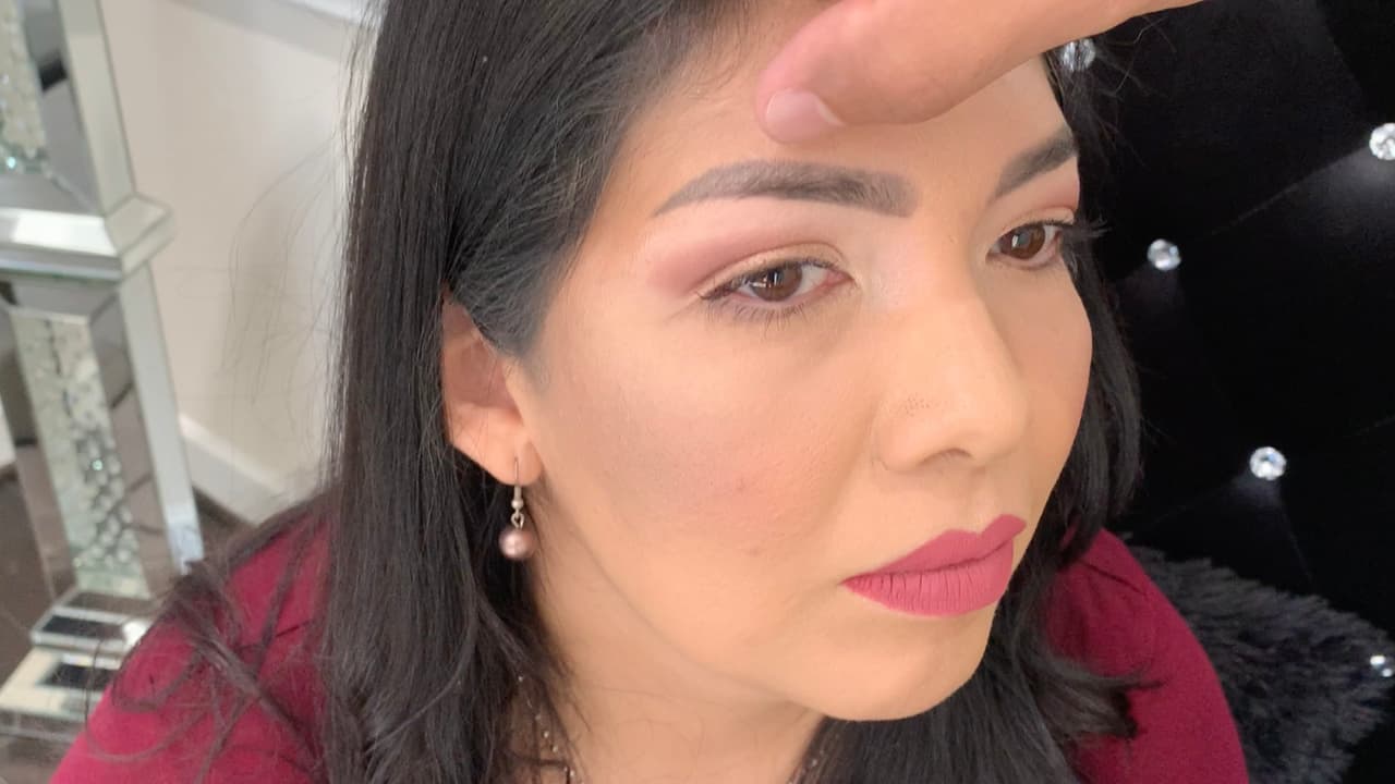 Después habrá que esperar entre 30 a 60 días para la cicatrización para hacerle un nuevo procedimiento para arreglarle las cejas.