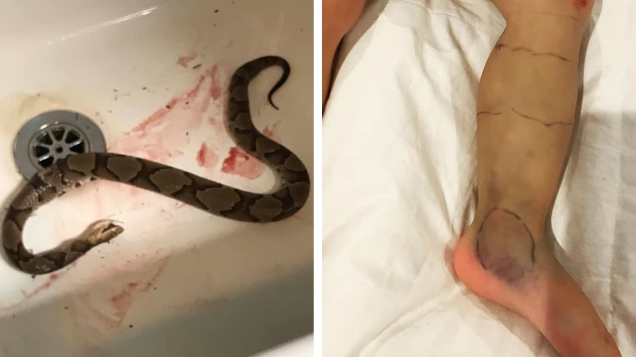 La familia compartió fotos de la pierna de la niña en Facebook, mostrándola hinchada y con hematomas. También publicaron 
<a href="https://www.facebook.com/photo?fbid=10102769585396028&set=pcb.10102769587866078" target="_blank">una foto de la serpiente muerta</a>, que parecía tener unos 2,5 pies de largo.