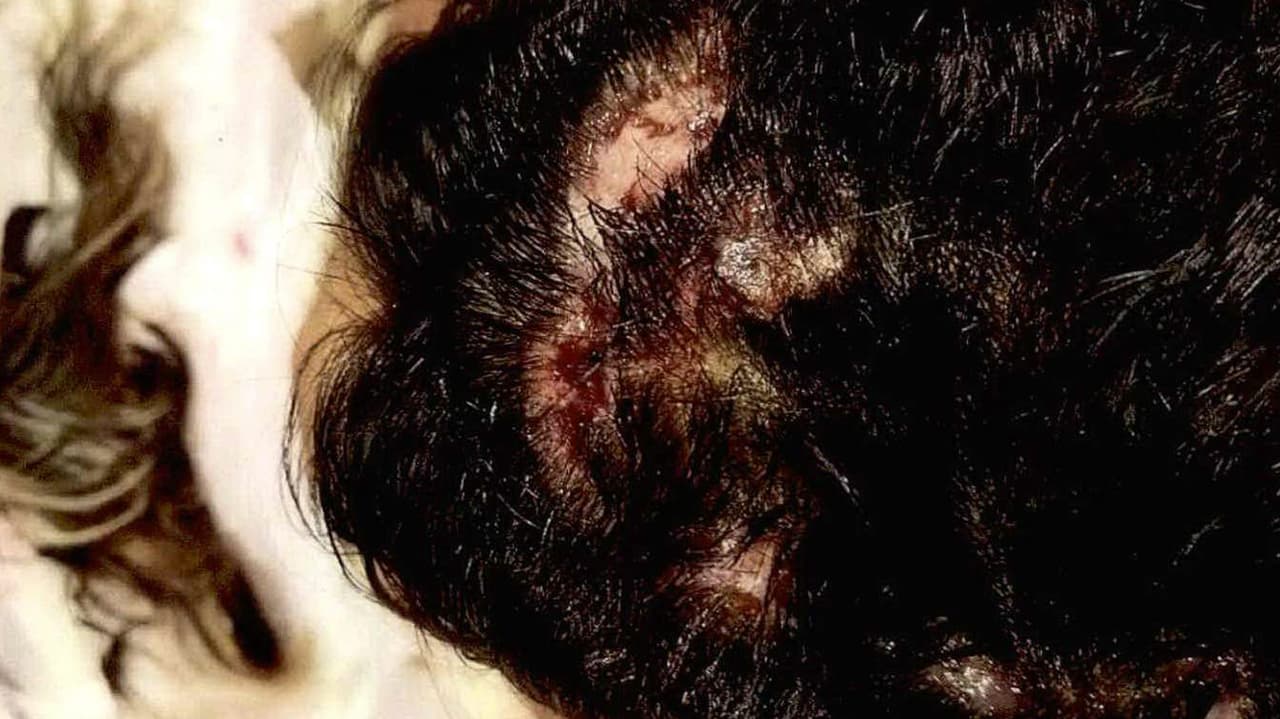 Los primeros días, después de la exposición al producto, se le hicieron huecos en su cabeza.