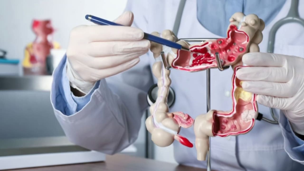 ¿Cuáles son las pruebas caseras y económicas que ayudan a detectar el cáncer de colon en adultos jóvenes?