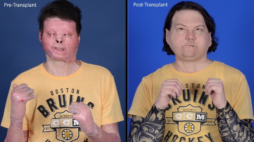 El doctor Rodríguez cuenta que fue entonces cuando le plantearon la posibilidad de realizar dos arriesgados
<a href="https://www.univision.com/temas/trasplantes">trasplantes</a>: el de rostro y manos, que se habían intentado solo dos veces en el mundo con riesgo de muerte.
<b>Los trasplantes de rostro son unos de los procedimientos más inusuales en la cirugía</b>. Uno de los problemas más recurrentes es el de
<b>encontrar un donante</b>. Ya entrado 2020, los médicos se enfrentaron al problema de hallar donantes a causa de la pandemia de
<a href="https://www.univision.com/temas/coronavirus">covid-19</a>.