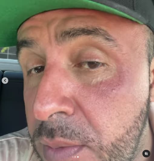 En el clip, Rivera hizo hincapié en lo rojo que se veía su rostro, exceptuando el área que rodea a los ojos, tras el tratamiento.
<br>