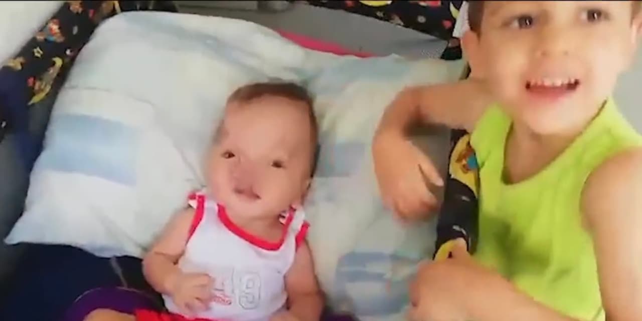 Ahora, con 15 meses de edad, Emiliano pasa sus días en su natal Bucaramanga, 
<a href="https://www.univision.com/temas/colombia">Colombia</a> luchando por su vida mientras balbucea para intentar comunicarse con su valiente madre, la cual se ha entregado para cuidarlo por completo y con la esperanza de que 
<b>algunos procesos quirúrgicos ayuden a su bebé a crecer como un adulto funcional. </b>
<br>