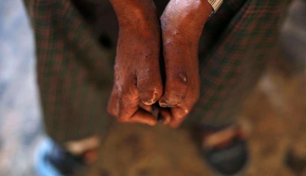 Manos de una persona con lepra