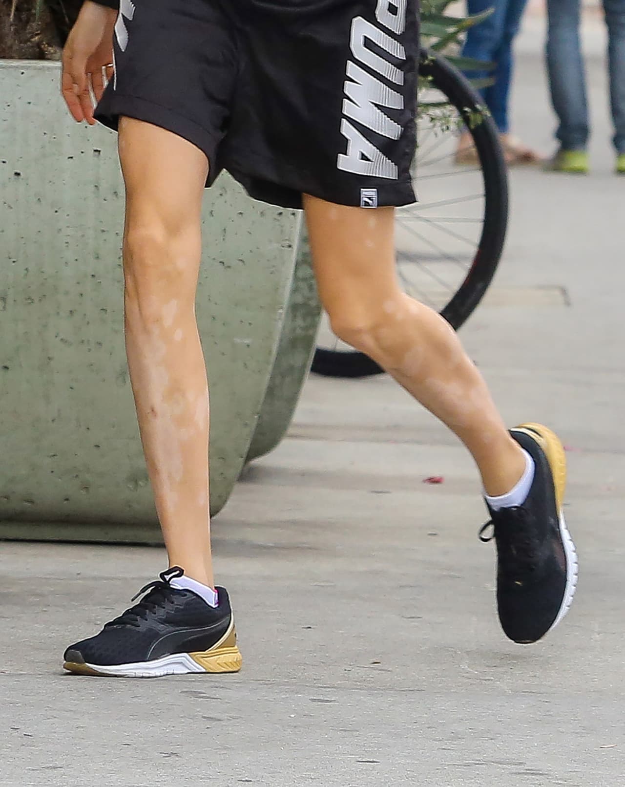 Además, las marcas de la psoriasis son notorias.