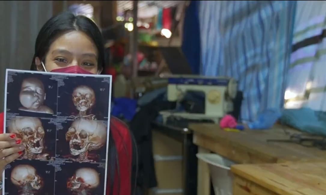 Sobre la deformación, la madre del pequeño explica que la biopsia realizada por los doctores arrojó que el niño tenía una displasia fibrosa, “un hueso en el rostro, por lo que tienen que cortarle; prácticamente volver a formar la parte de su cara”. 
<br>