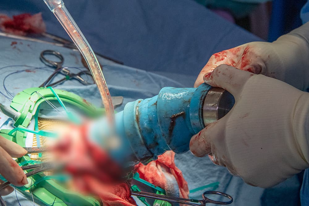 El procedimiento tardó al menos tres horas. 
<br>