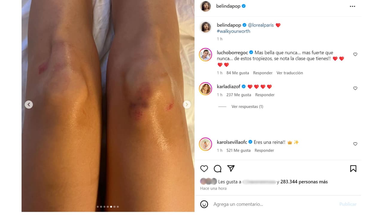 La cantante mostró las lesiones que le dejaron su caída en París.