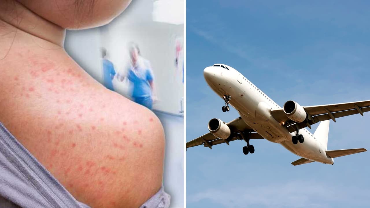 México emite alerta de viaje por brote de sarampión para personas que planean visitar Texas