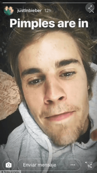 Justin ha padecido acné en distintas etapas de su vida. En 2018, publicó una historia en Instagram donde, con humor, mostró una espinilla que brotó en su rostro: "
<b>Las espinillas están de moda"</b>, era el mensaje que se podía leer en aquella publicación.