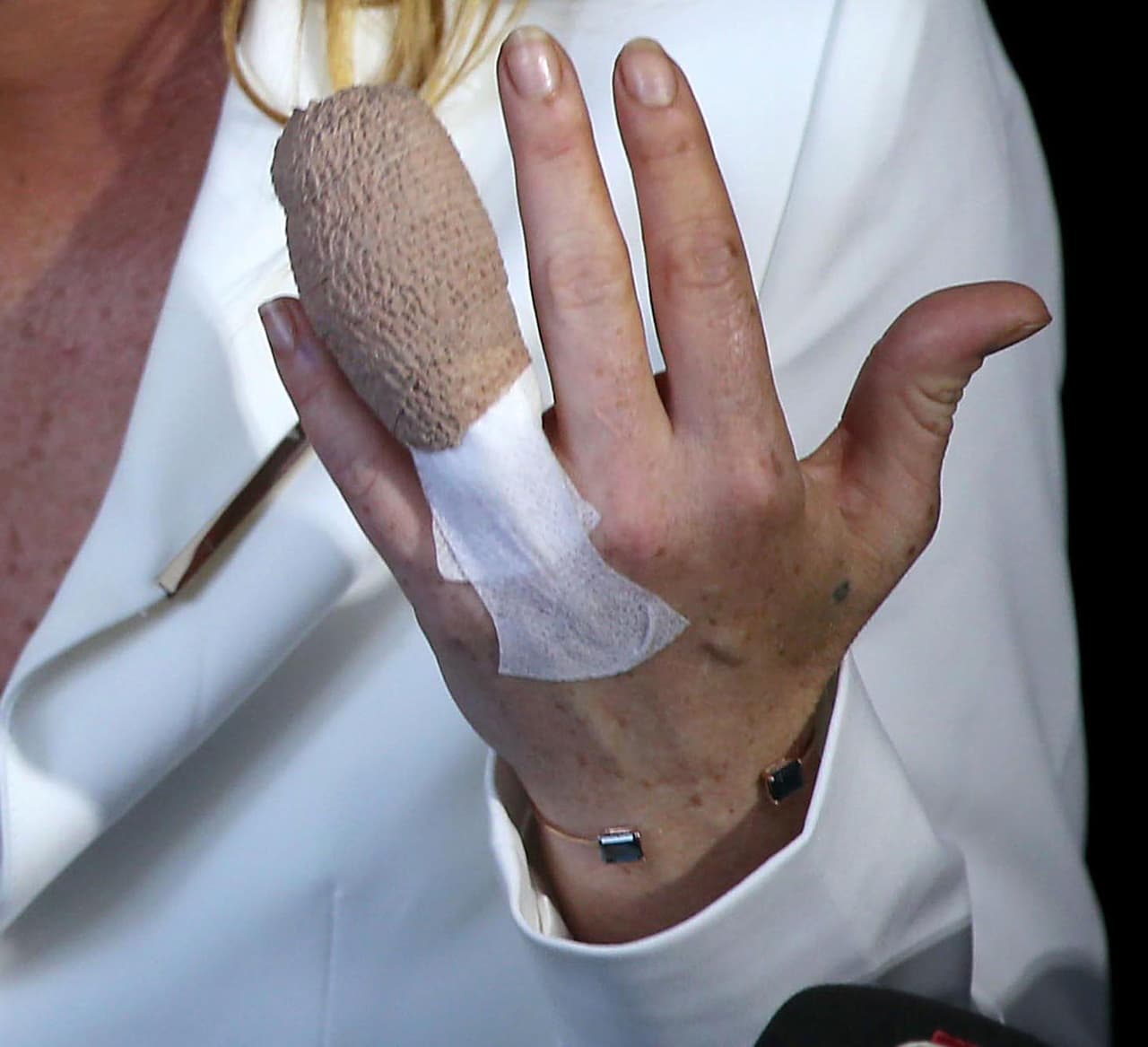 Por poco pierde parte de su dedo, afortunadamente pudo recuperarlo y en urgencias por medio de una cirugía pudieron arreglarlo.