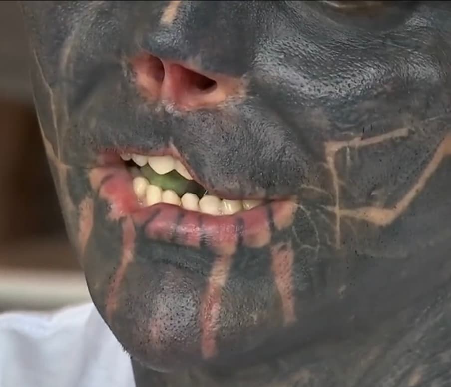 Como su imaginación se lo dictaba, Loffredo se cortó los labios, se afiló los dientes, se quitó la nariz y se mutiló sus orejas. De todas estas transformaciones, él cuenta que
<b> tuvo dificultades para comer y beber</b>, además de sufrir un poco por no saber de dónde provenía el ruido que iba captando. 
<br>