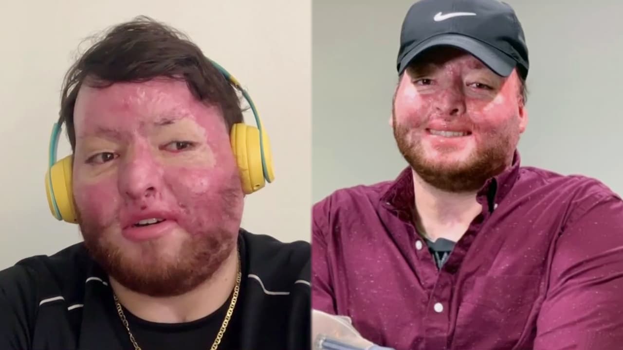 Conocimos la historia de 
<a href="https://www.univision.com/shows/despierta-america/explosion-de-gas-dejo-a-este-joven-boricua-con-graves-quemaduras-hoy-su-consejo-toca-corazones-nunca-se-rindan-video">Alexis Joel Hernández</a>, que es mucho más que inspiradora y un ejemplo para que "nunca se rindan".