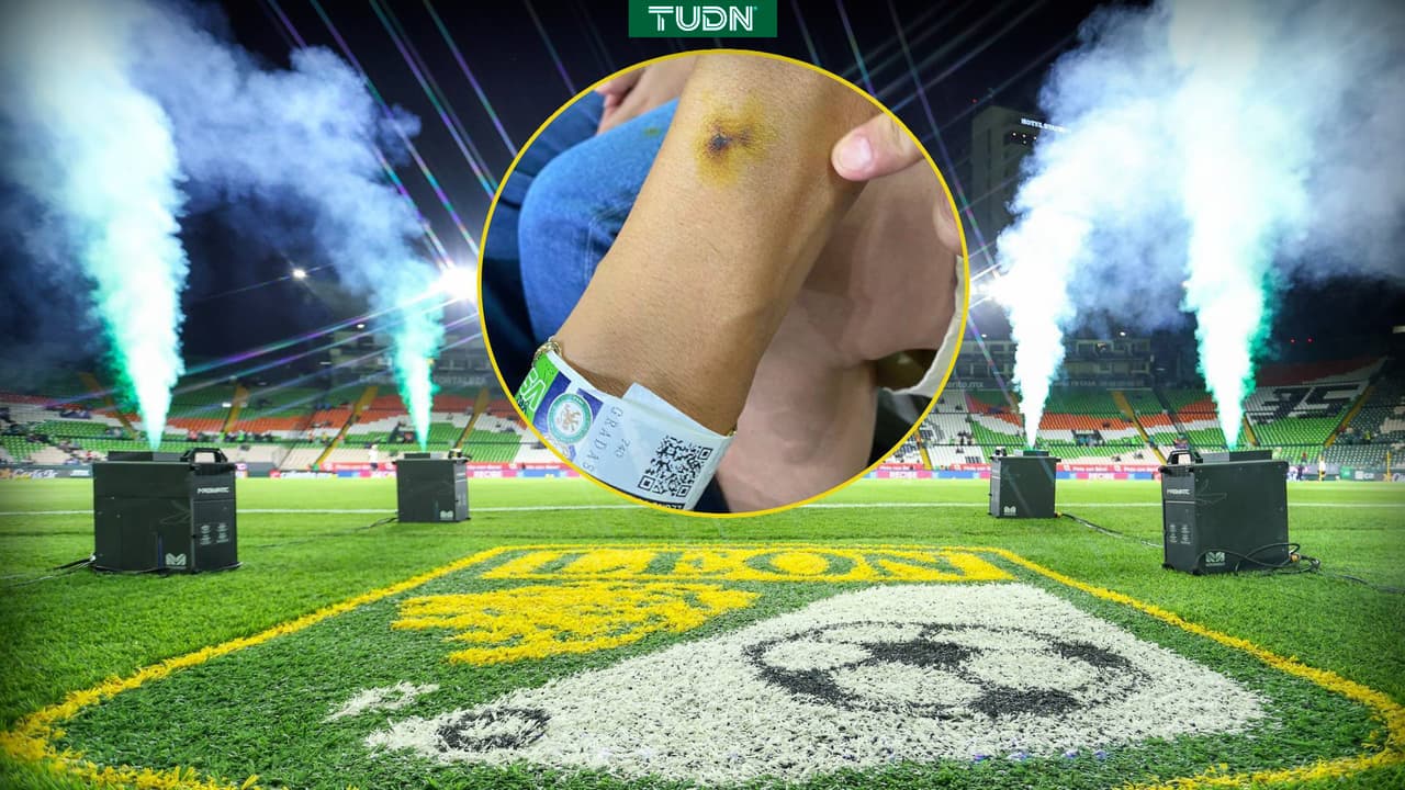 Aficionado del León muestra quemadura por pirotecnia del Club León