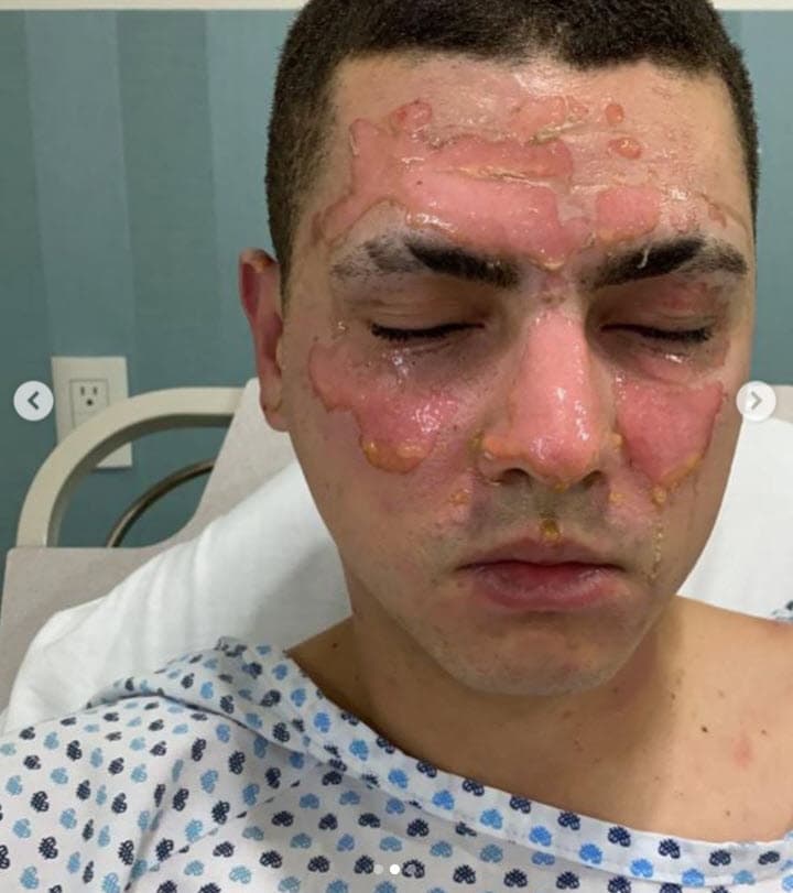 "¡Me llevé
<b>un susto cabr***n</b>!", escribió en Instagram el domingo 24 de octubre, "fue mi culpa, dejé una llave de gas abierta, casi nada, y con eso, ¡bastó para que pasara esto!".
<br>