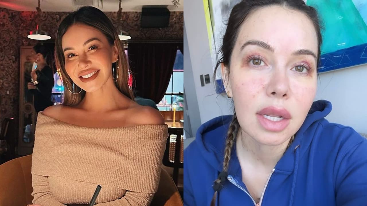 Chiquis se somete a cirugía y fuerte tratamiento estético: aparece llena de moretones