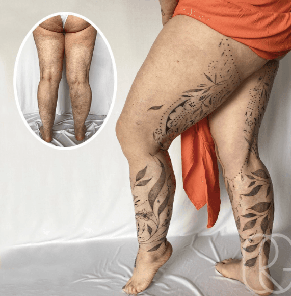 Como hemos visto trabaja con todo tipo de marcas; a esta mujer le llevó 9 días terminar el grabado artístico en sus quemaduras que sufrió en un accidente doméstico cuando era niña. Entre flores, hojas y puntos hizo que volviera a amar su cuerpo.