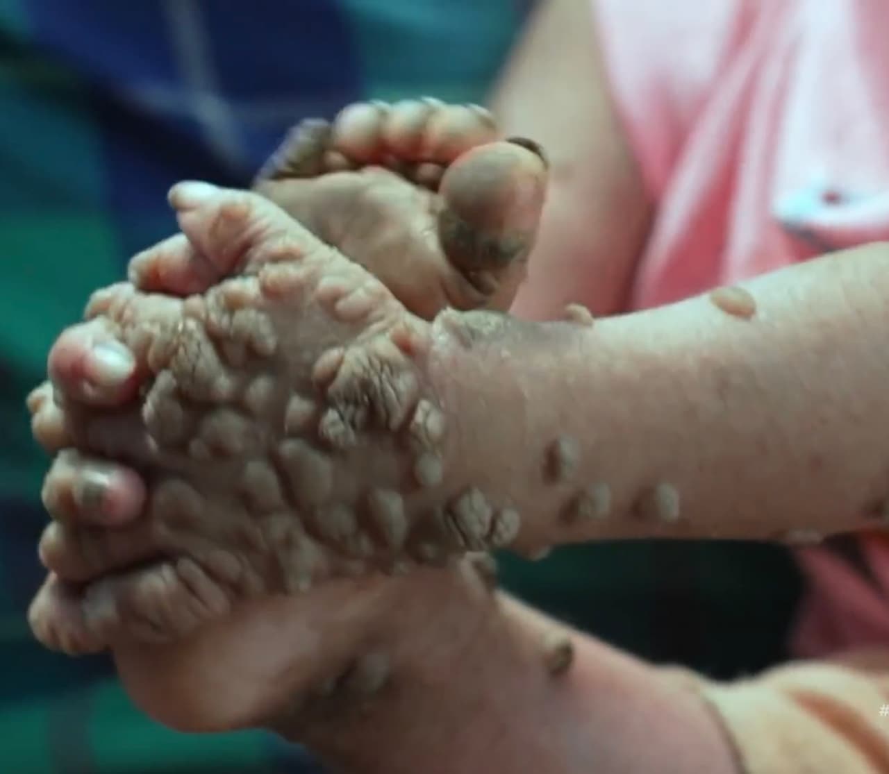 Por eso, el máximo sueño de ambas niñas es poder curarse para ir tranquilas a la escuela para poder estudiar, sin los comentarios que puedan decir sus compañeritos.
<br>