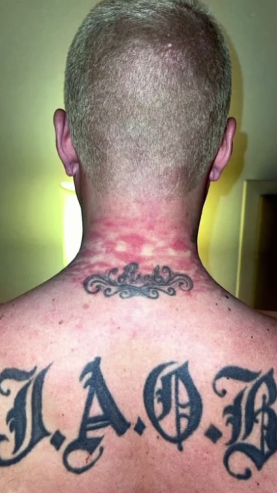 Desafortunadamente, horas después de la gala J Balvin compartió con sus seguidores que los collares que lució le pasaron factura y le ocasionaron estas lesiones en el cuello.