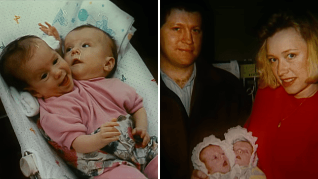 Abby y Brittany Hensel de bebés