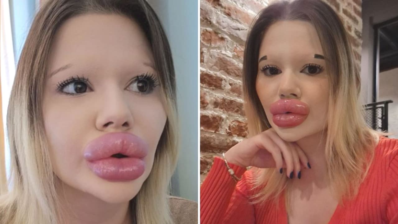 Mujer pagó miles de dólares por "los labios más grandes del mundo": impacta con su apariencia