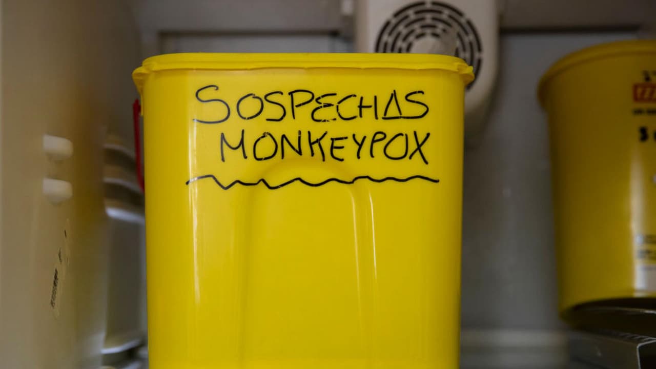 <b>¿Hay vacunas disponibles contra la viruela del mono?</b>
<br>
<br>Si, en California y el condado de Los Ángeles, hay vacunas disponibles. Sin embargo, por el momento, las inyecciones son administradas de forma limitada a las personas bajo riesgo. Encuentra la información sobre 
<b>centros de vacunación y citas en el condado de Los Ángeles en este <a href="https://www.univision.com/local/los-angeles-kmex/vacunas-viruela-mono-monkeypox-condado-los-angeles" target="_blank">enlace</a>.</b>