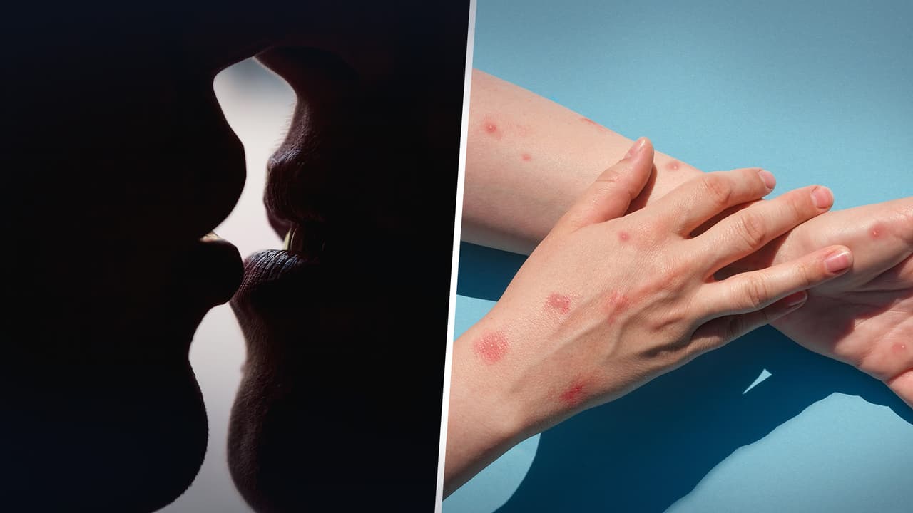 Sexo virtual y otras medidas del condado Dallas para prevenir la viruela del mono