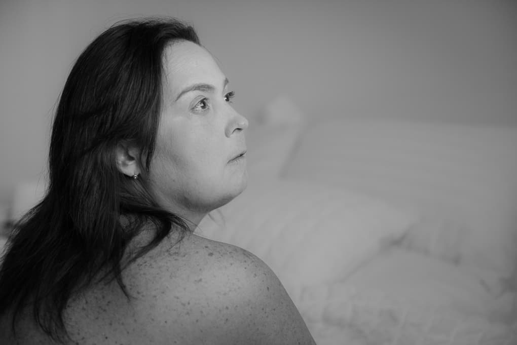  Vivir con la enfermedad de la mujer de piedra: "Mi cara tenía aspecto de máscara"