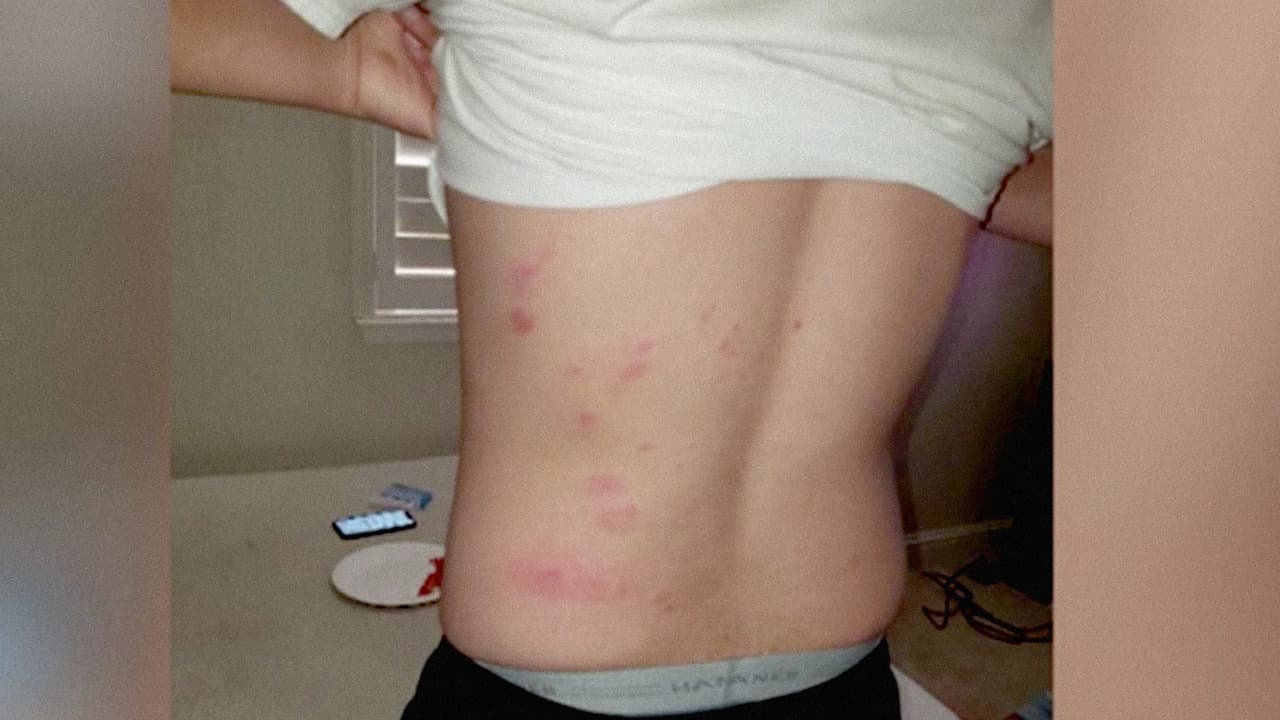 Esta familia hispana de Modesto no comprendía cómo se originaron estas picaduras.