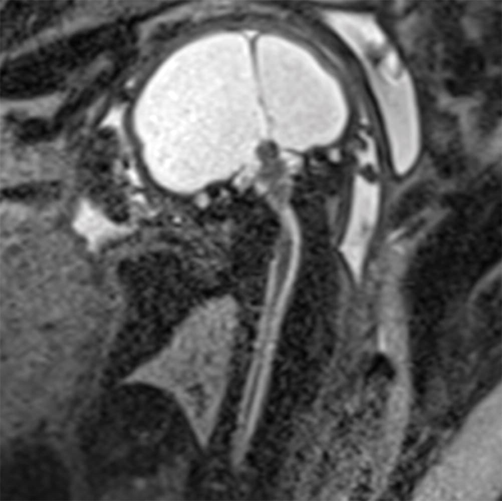 Su tronco cerebral también es más delgado de lo normal.