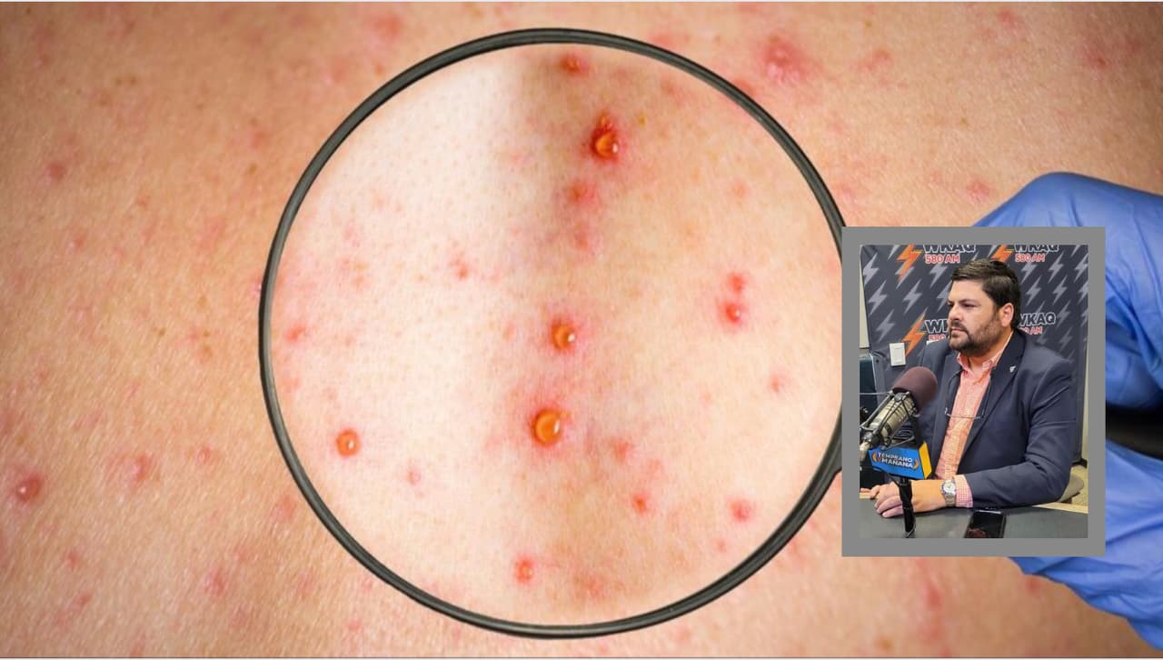 Confirman dos nuevos casos de viruela del mono en Puerto Rico