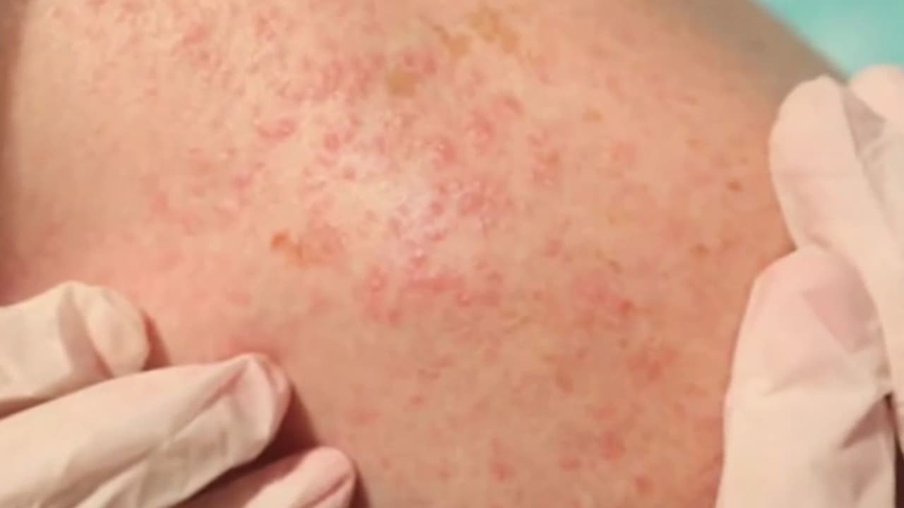 Médico da recomendaciones por brotes de sarampión y ciclosporiasis en EEUU