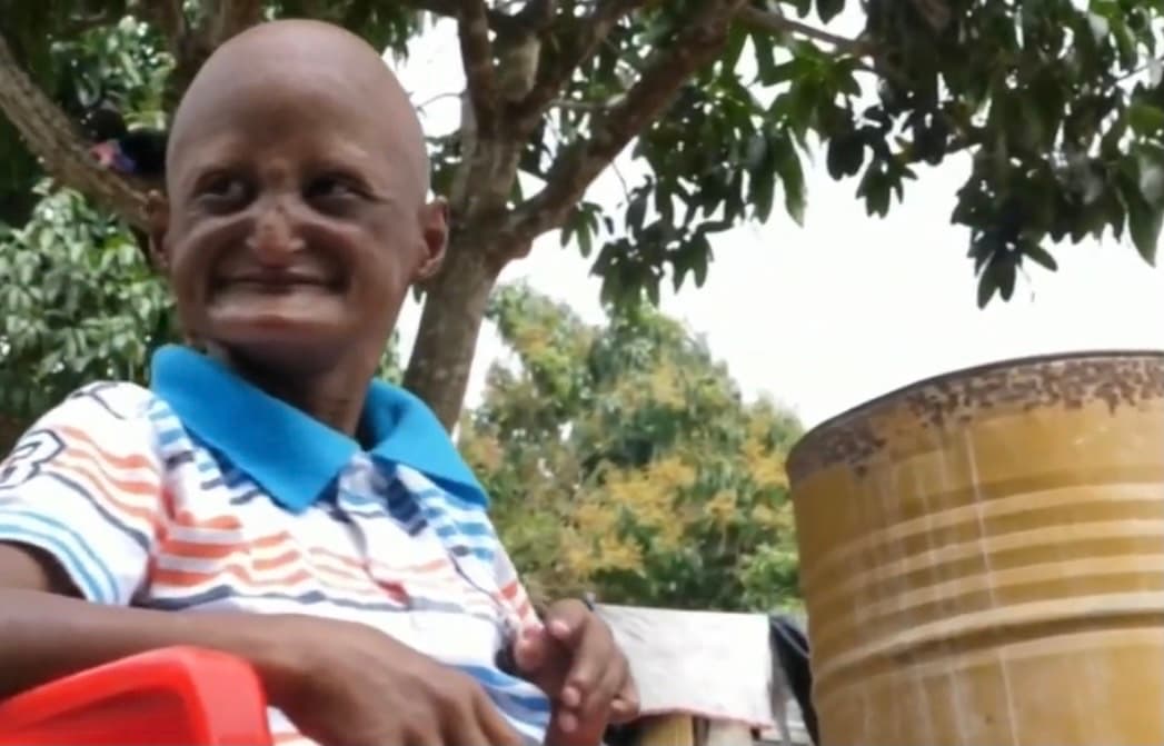 Walmeli del Rosario es un joven dominicano de 23 años pero que tiene el tamaño de un niño, el rostro arrugado y una prematura calvicie que lo hacen lucir casi como un anciano debido a que padece una rara 
<a href="https://www.univision.com/temas/enfermedad">enfermedad</a>. 
<b> "Estoy desesperado", alcanza a decir con una tenue voz aguda. </b>
<br>