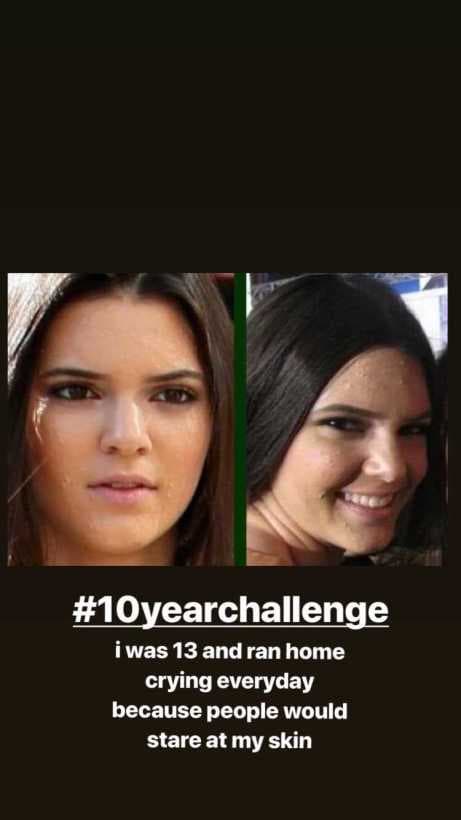 Aprovechando el reto de los 10 años, que se popularizó a principios de 2019 en las redes sociales, la mayor de las hermanas Jenner mostró una fotografía de 
<b><a href="https://www.univision.com/entretenimiento/celebridades/la-triste-revelacion-de-kendall-jenner-al-compartir-su-fotografia-del-10yearschallenge-fotos">su rostro en la adolescencia.</a></b>