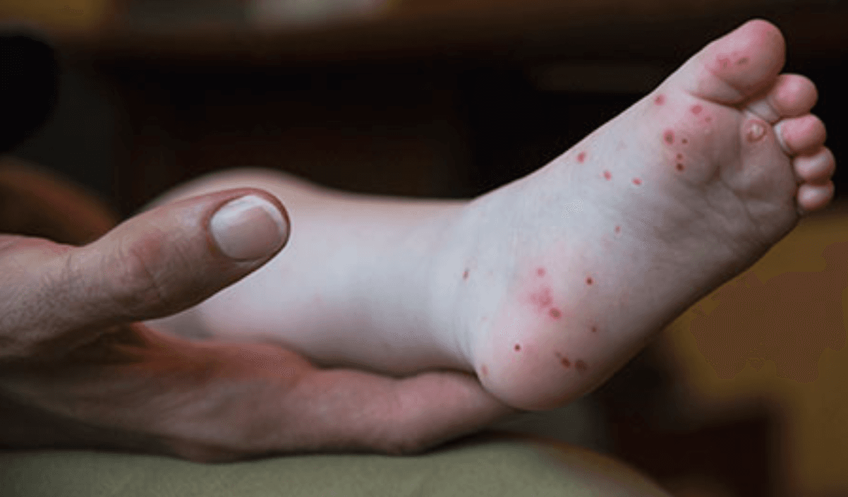 Su síntoma más característico es un sarpullido que no pica, de puntitos rojos en la palma de las manos y los pies, y a veces en las rodillas, codos, nalgas o el área genital. También dolorosas llagas en la boca que normalmente comienzan como puntitos rojos planos.
<br>