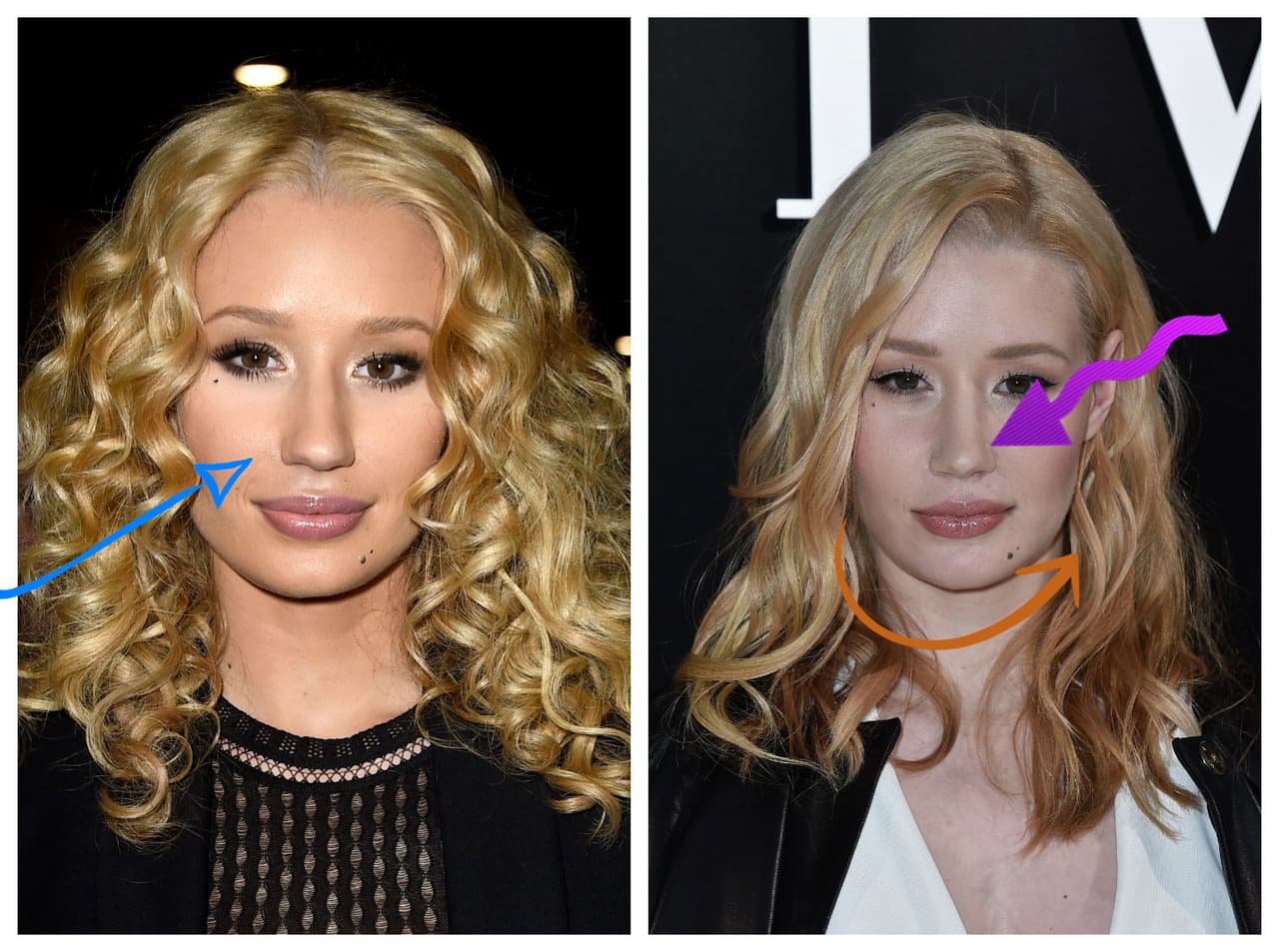 Iggy Azalea se ha hecho diversas operaciones, en esta imagen puedes notar cuáles han sido sus cambios. Se hizo reducción de mandibula, botox en las mejillas y la nariz más afilada.
