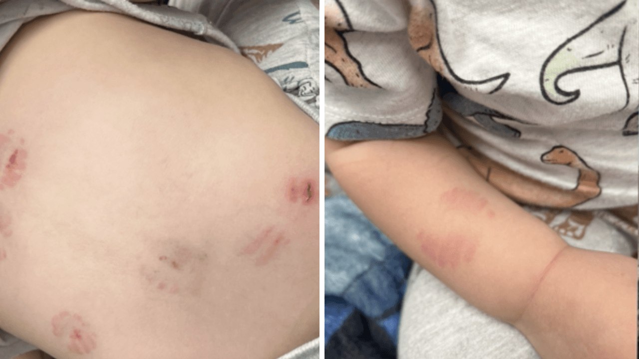 Padres de un niño demandarán por $1 millón a guardería donde alegan que recibió 8 mordidas en su cuerpo