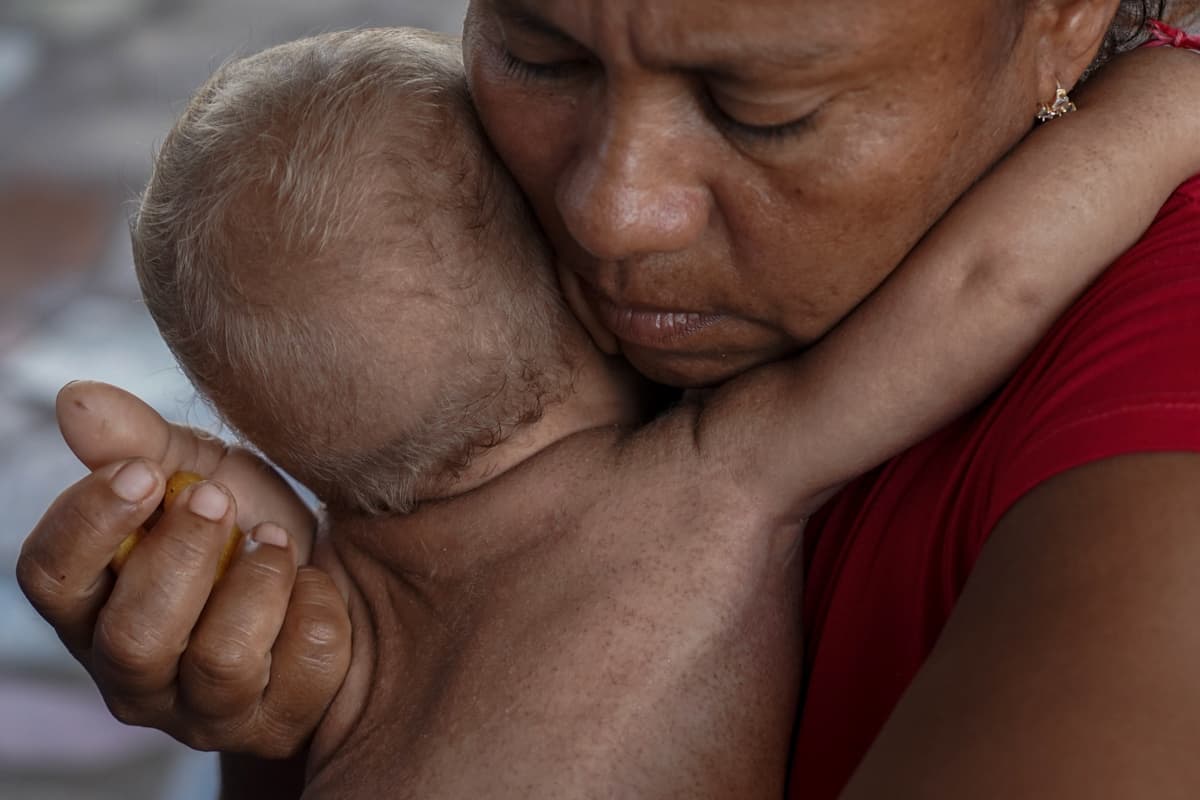 Jendriannys llegó al operativo con síntomas de desnutrición severa.