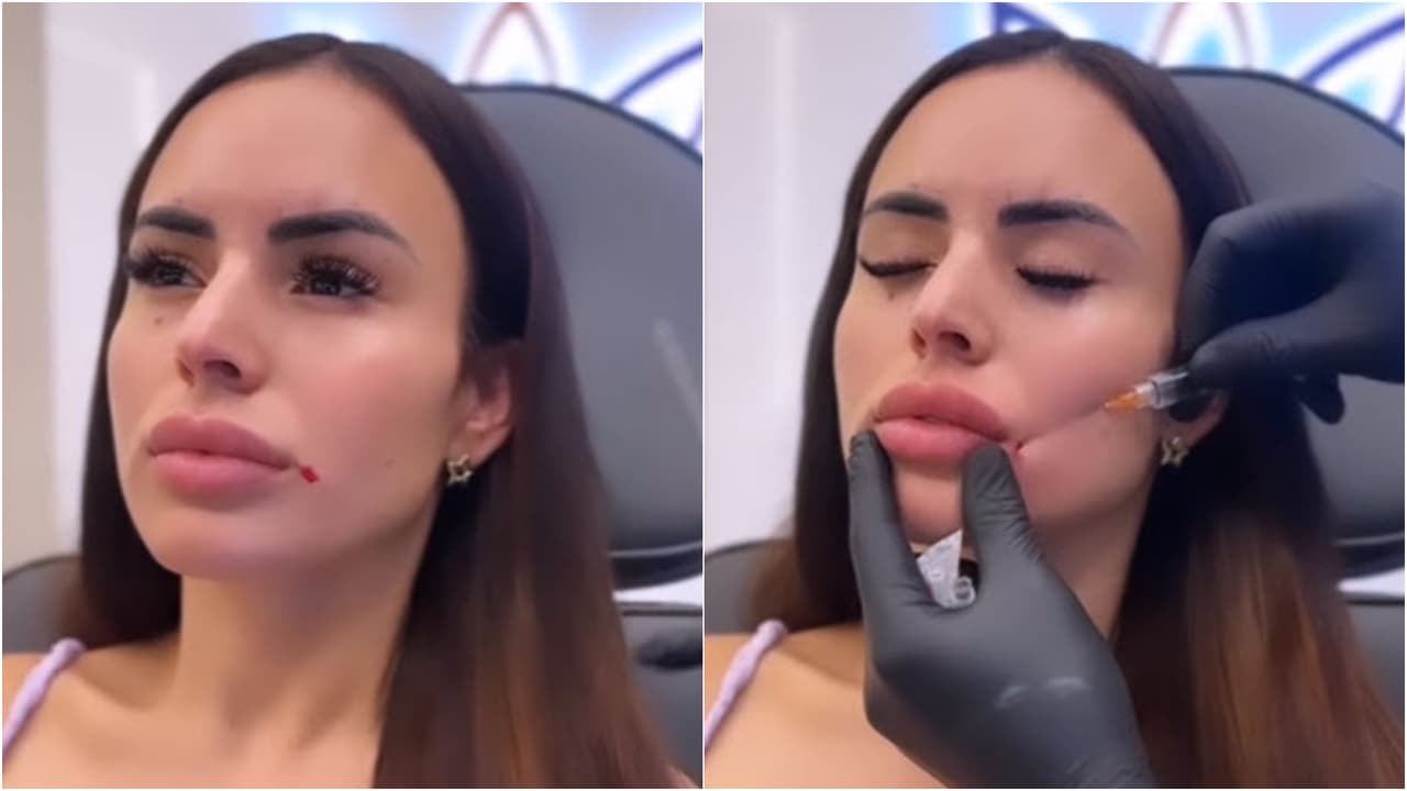 Evelyn Beltrán se despidió del relleno en sus labios.