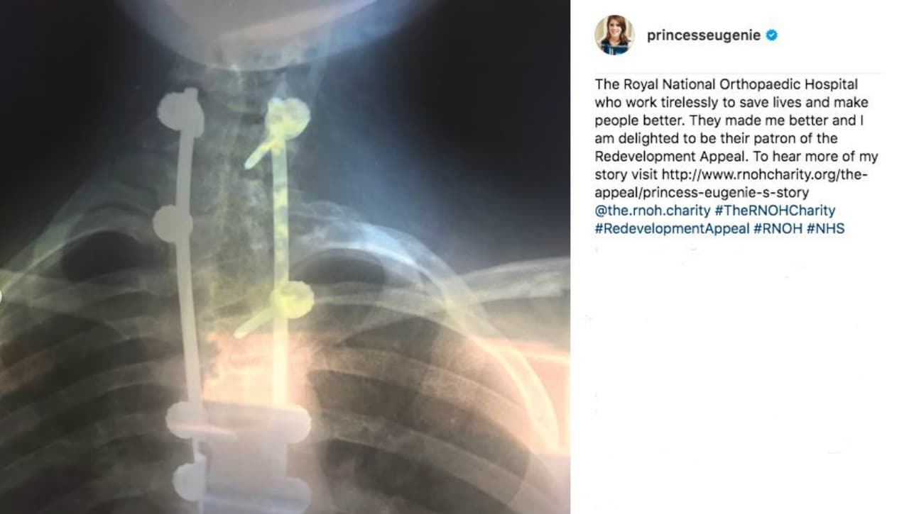 Ya había 
<b><a href="https://www.instagram.com/princesseugenie/">compartido su experiencia en Instagram</a></b>, pero este viernes aprovechó para llegar a más personas. Cuando 
<b>Eugenie de York</b> tenía 12 años, la sometieron a una cirugía para corregir los efectos que 
<b><a href="https://medlineplus.gov/spanish/scoliosis.html">la escoliosis</a></b> le estaba causando. El día antes de la operación, confesó que sintió terror.
