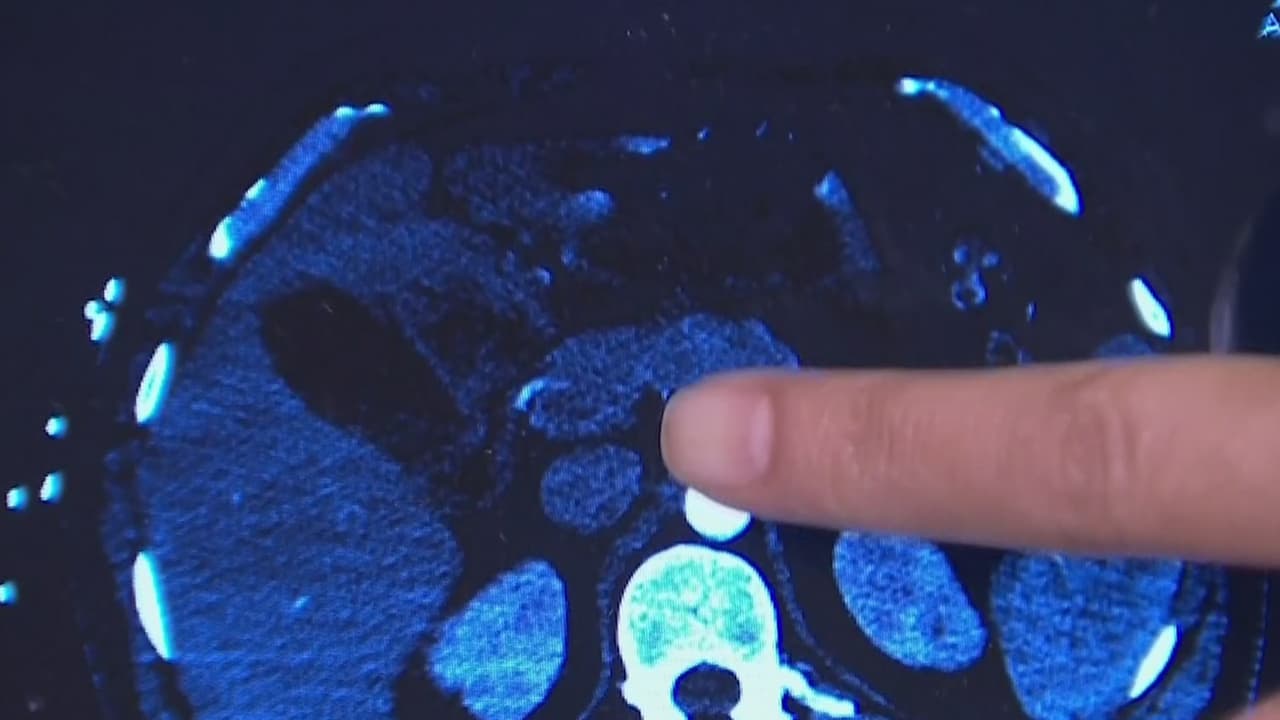 Latino de Chicago lucha contra un parásito que podría haber adquirido por comer carne mal cocida