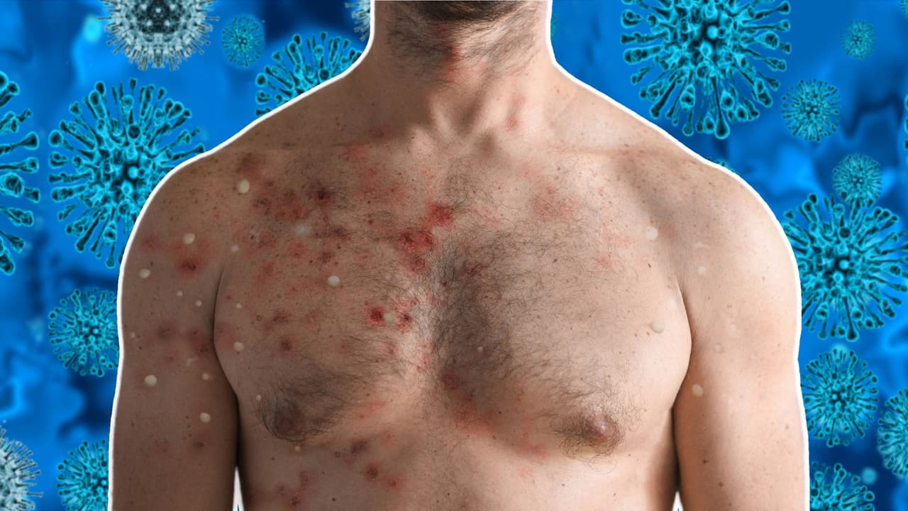 ¿Qué significa la emergencia de salud pública en San Francisco por la viruela del mono?