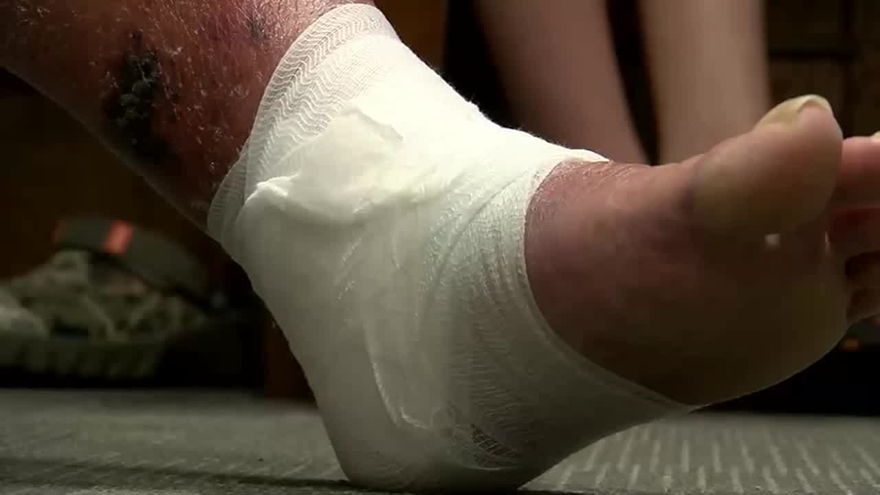 “Cualquiera debe ser cauteloso antes de meterse en la playa”: nueva víctima de la bacteria “come carne”en Florida