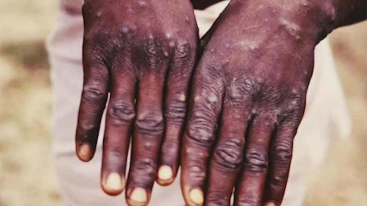 Viruela del mono: niños o adultos, ¿quiénes están más expuestos a esta enfermedad?