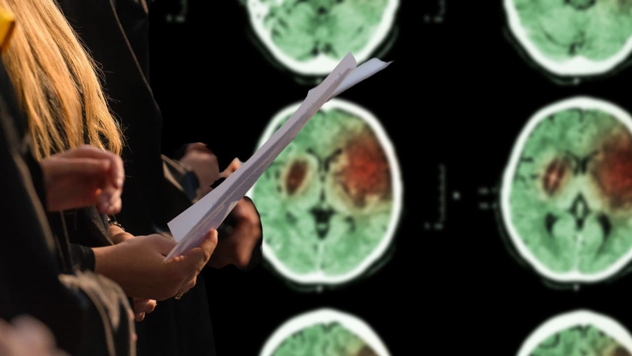 Canto coral puede ayudar a los sobrevivientes de accidentes cerebrovasculares a recuperar el habla