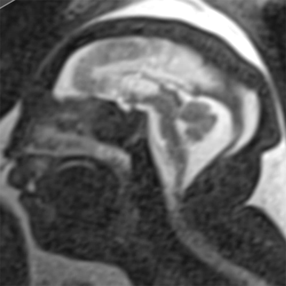 La madre, de 24 años, tenía 9 semanas de embarazo de gemelos cuando tuvo una erupción.