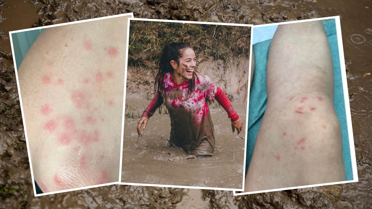 Participantes de reto de lodo y agua fangosa presentan este preocupante sarpullido