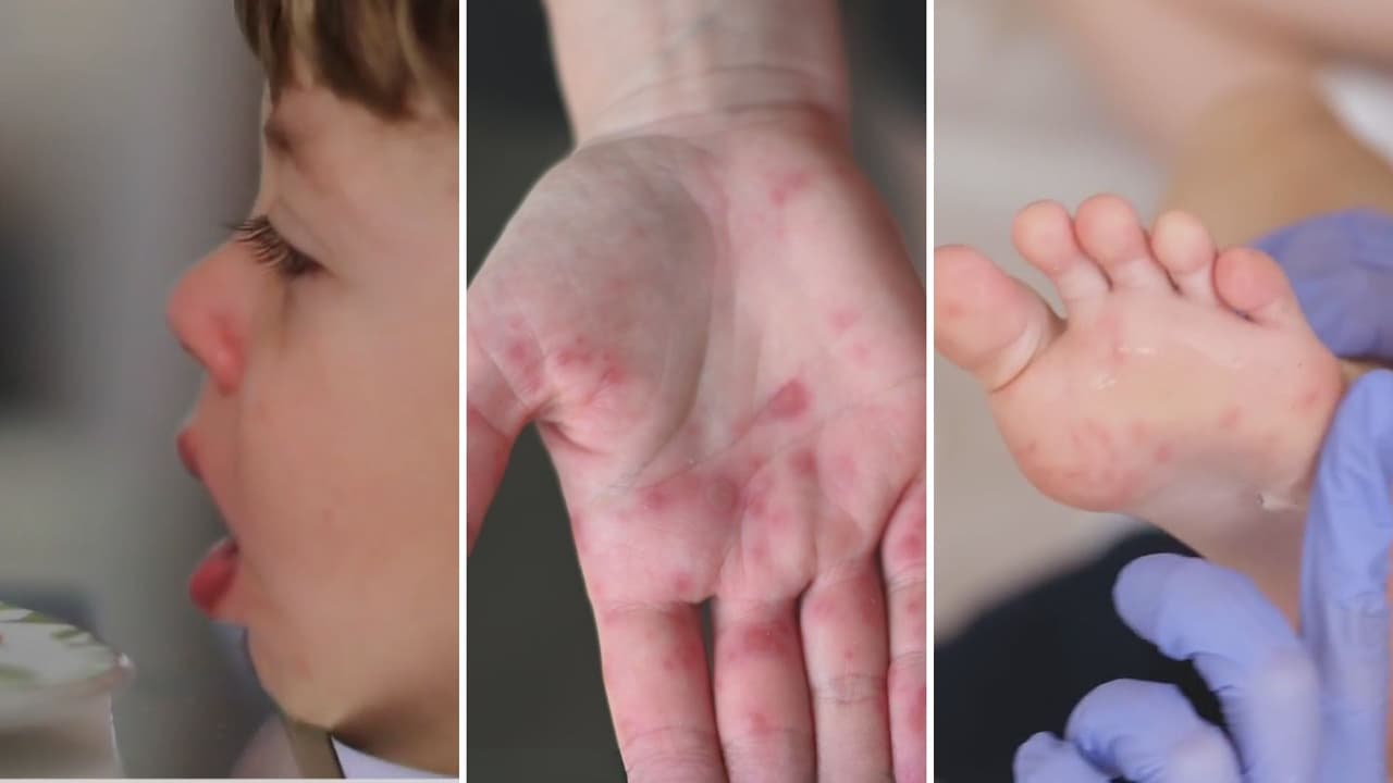 Aumentan casos de la enfermedad ‘manos, pies y boca” en el Valle Central: ¿cuáles son los síntomas?